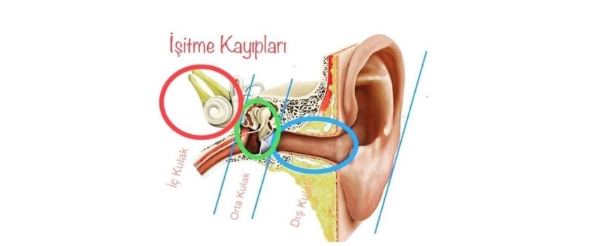Isitme Kaybi Turleri