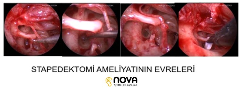 Stapedektomi Ameliyatinin Evreleri